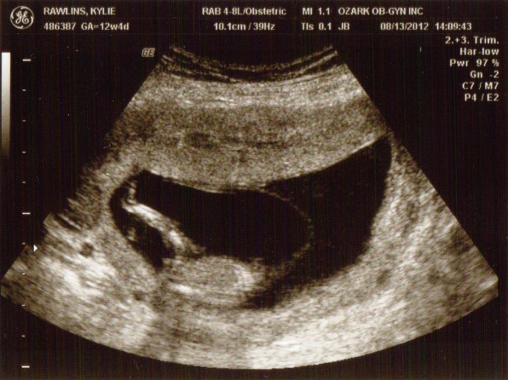 Ultrasound Week 12