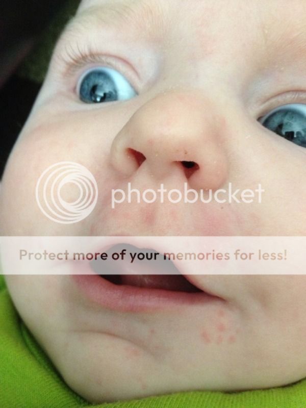 Is this eczema? BabyCenter